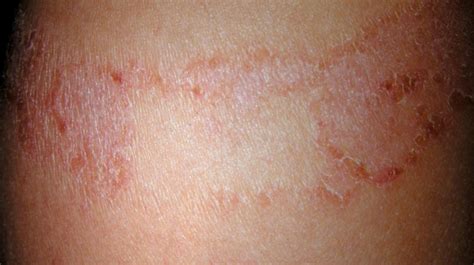 Rash 22 Common Skin Rashes Pictures Causes And Treatment