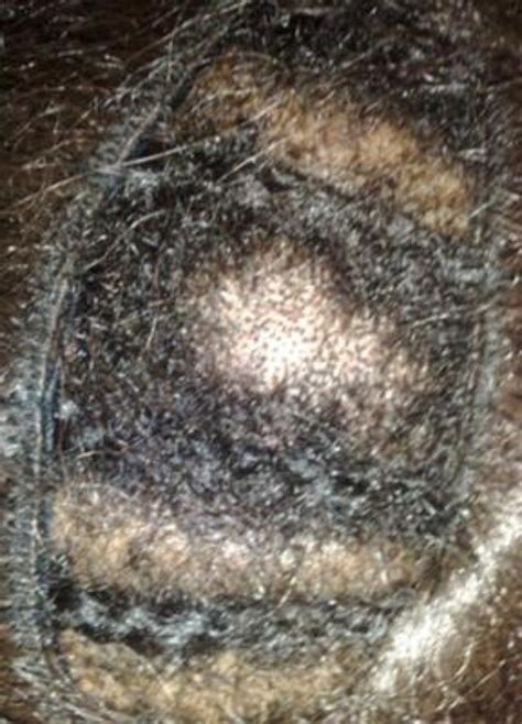 Flakes from dry skin are smaller sometimes, sensitivities to some kind of ingredients in those commercial hair care products could lead to an itchy. African American Hair: Dry Scalp Treatment - Curly Chic