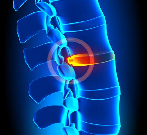 Bulging Disc Treatment Minimally Invasive Spine Surgery