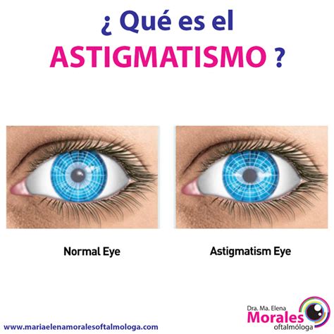 Astigmatism How It Affects Vision And How It Is Treated LakaPerai