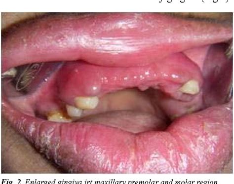 Figure From Orofacial Granulomatosis A Rare Case Report With Review