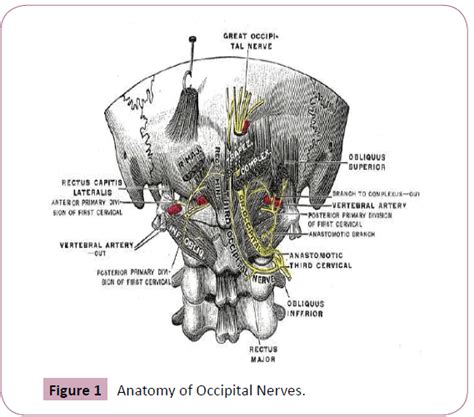 Bilateral Occipital Neuralgia