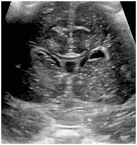 Intracerebral Periventricular Cysts In Newborn Connatal Cysts Eurorad