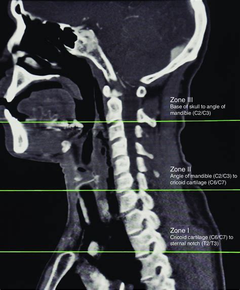 Roon And Christensens Classification 4 Of Neck Zones As Seen On