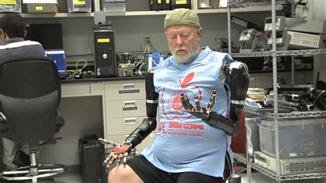Amputee Makes History With Apls Modular Prosthetic Limb Youtube