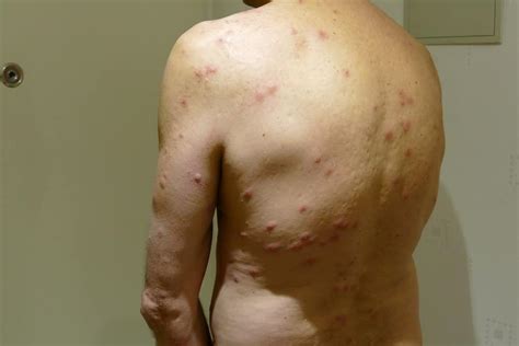 Bed Bug Rash Symptoms And Treatment Pestseek