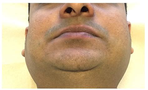 Parotid Gland Swelling During The Course Of Sjögrens Syndrome