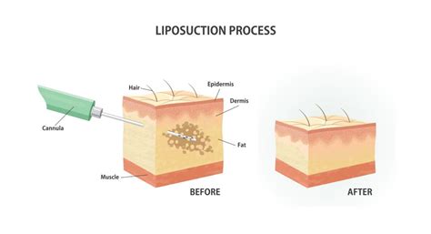 A Quick Guide To Liposuction For Men Dr Timothy Alexander