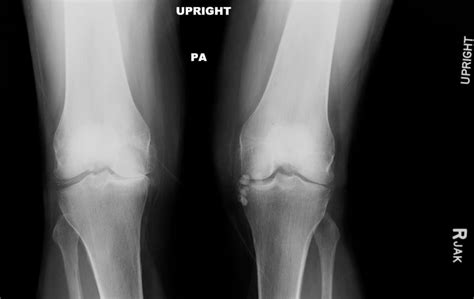 Orthodx Pain Relief For Knee Osteoarthritis Clinical Advisor