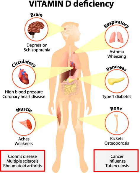 Recognizing The Signs 10 Common Symptoms Of Vitamin D Deficiency