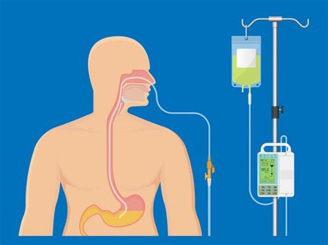 Feeding Tubes — What You Should Know Roswell Park Comprehensive