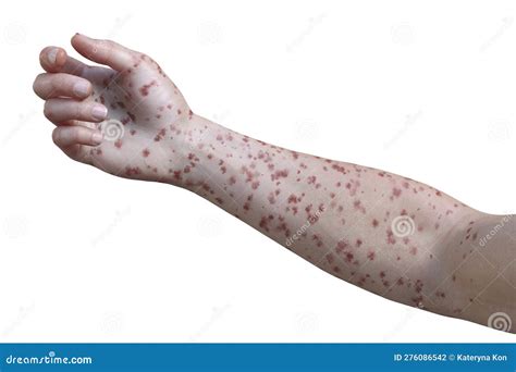 A Skin Rash On The Arm Of A Patient With Marburg Hemorrhagic Fever 3d