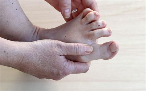Dry Skin In The Foot Associated With Cancer Treatment Consulting Footpain