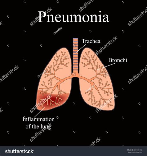 Pneumonia Anatomical Structure Human Lung Illustration Ilustración De