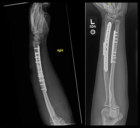 Radius Ulna Shaft Both Bone Forearm ORIF