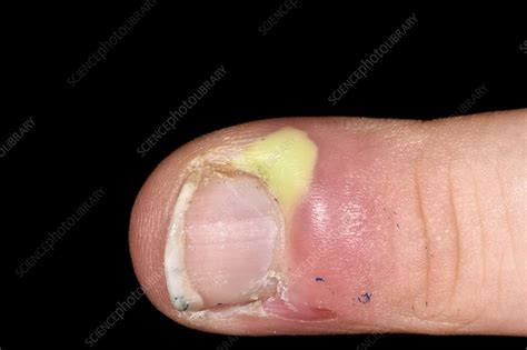 Paronychia Infection Stock Image C0478424 Science Photo Library