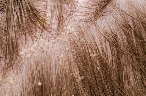 Dandruff is not a serious medical condition and is relatively easy to treat. Psoriasis or dandruff? Symptoms, treatment, and tips