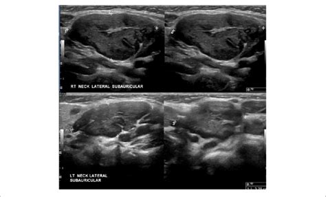 Neck Ultrasound Shows Several Enlarged Lymph Nodes In Subauricular