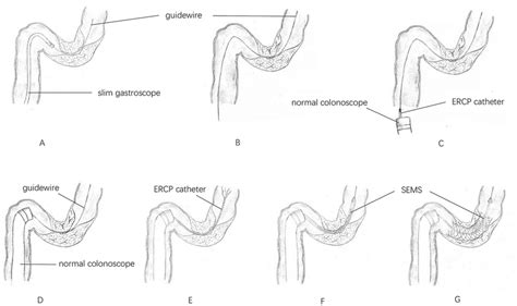 Stent Placement Assisted By A Slim Gastroscope With X Ray Ercp