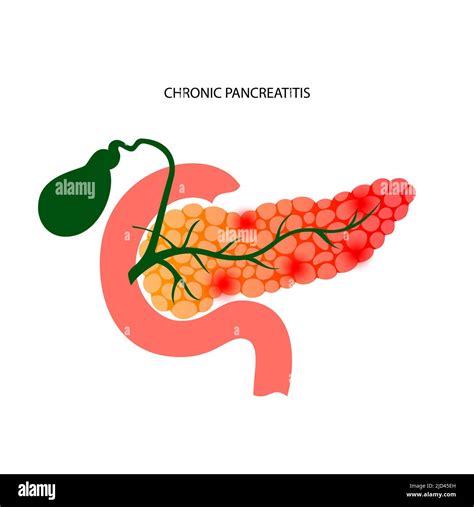 Chronic Pancreatitis Illustration Stock Photo Alamy