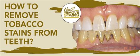 How can you remove stains from your teeth at home? How to remove tobacco stains from teeth  Detailed Answer 