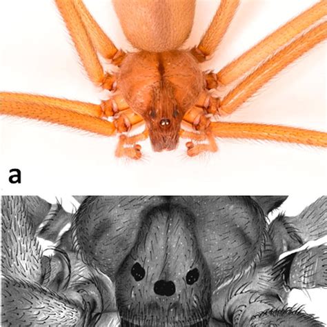 Clinical Picture Of A Child Bitten By A Loxosceles Spider In
