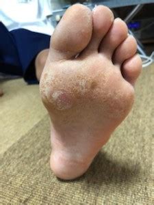 ギプスがかゆい時の解決法 棒とアルコール除菌タオルを使って ...