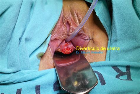 Divertículo de uretra femenino Dr Mauro Valentini