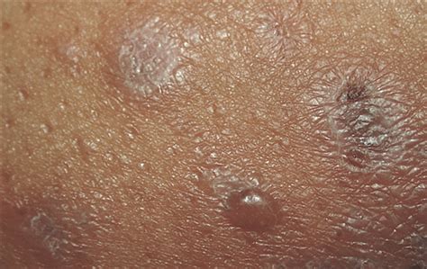 Vesicles In A Patient With A Lichenoid Eruption—quiz Case Dermatology