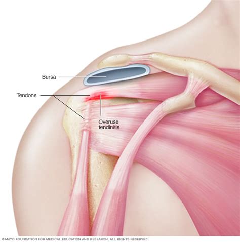 The biceps tendon attaches the biceps muscle to the shoulder and helps to stabilize the joint. Shoulder joint - Mayo Clinic