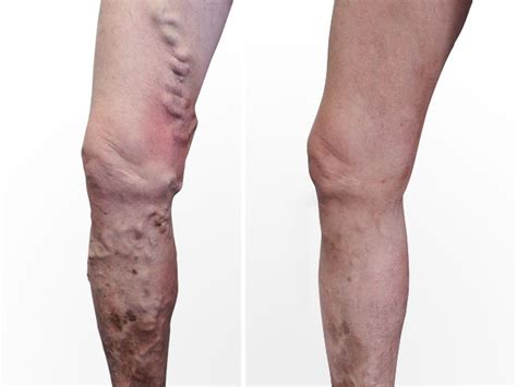 Varicose Vein Surgery Before And After Photos Palm Clinic