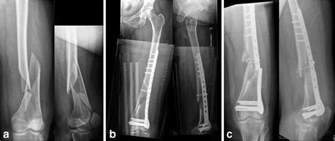 Patient 2 A Preoperative Xrays Of Distal Third Femoral Diaphyseal