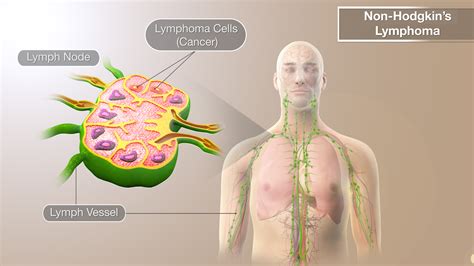 Non Hodgkins Lymphoma Non Hodgkin S Lymphoma Symptoms And Causes