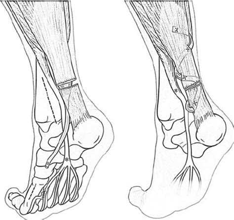 Left leg flexor tendon location / flexor tendon injuries orthoinfo aaos : Distal dissection of the flexor hallucis longus tendon (#) (left). ⇒... | Download Scientific ...