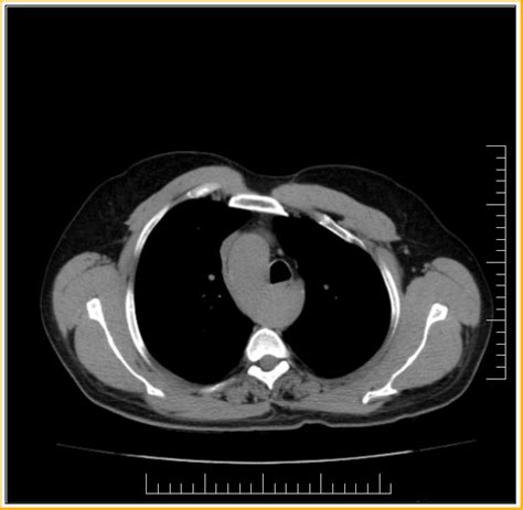 Right Sided Aortic Arch Ct Sumers Radiology Blog