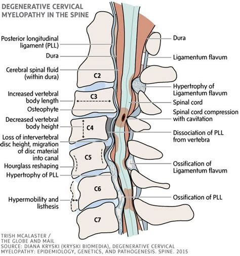 How To Recognize The Early Signs Of Degenerative Cervical Myelopathy