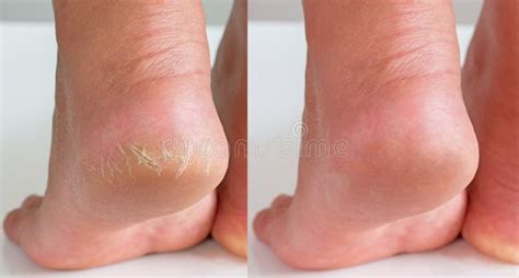 Image Before And After Treatment Of Dry Heels Cracks Skin Dehydrated