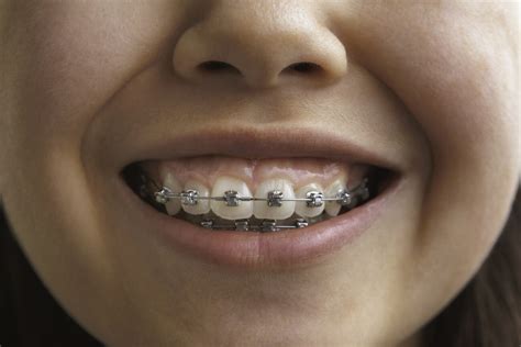 Two Phase Orthodontic Treatment In Mt Airy Md Woodbine