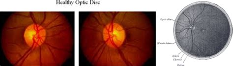 The Optic Nerve In Glaucoma Intechopen