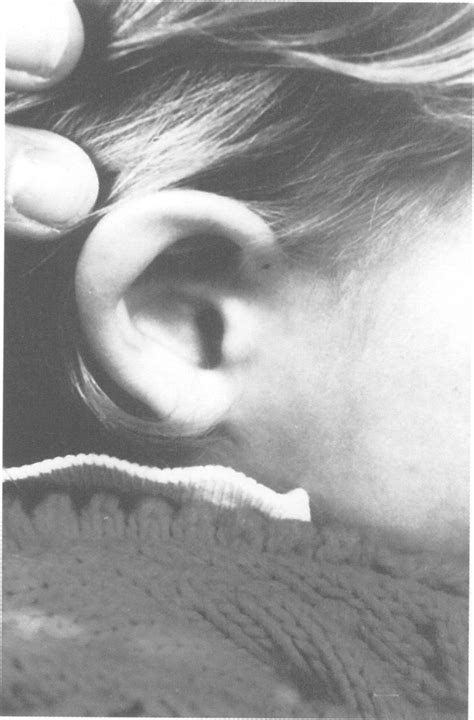 The Ear Of The Present Case Note The Thick And Flat Ear Helix And The