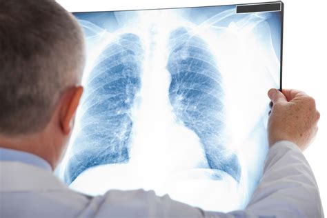 Nowotwór płuc rokowania jakie są przy raku płuc HelloZdrowie