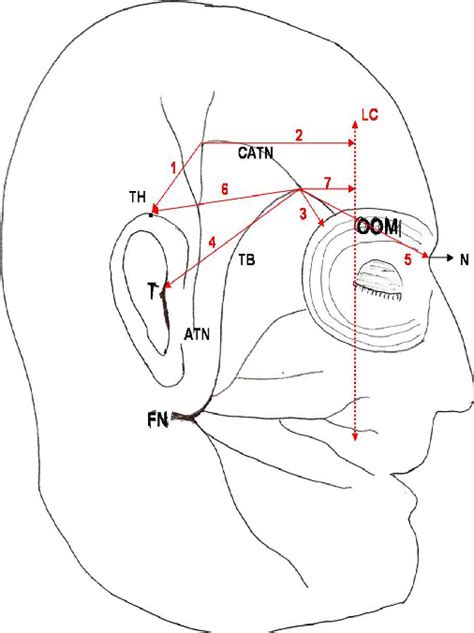 Figure 4 From Anastomosis Between The Temporal Branch Of Facial Nerve