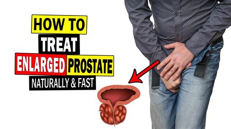How To Treat Enlarged Prostate Without Surgery Home Remedies For