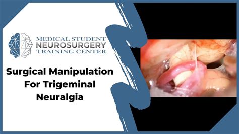 Surgical Manipulation For Trigeminal Neuralgia Youtube
