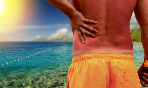 Hells Itch How To Treat A Severe Sunburn Itch