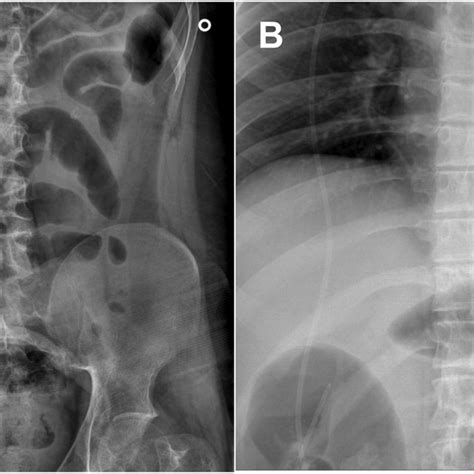 Anterior Posterior Plain Radiography Of The Abdomen A And Chest X Ray