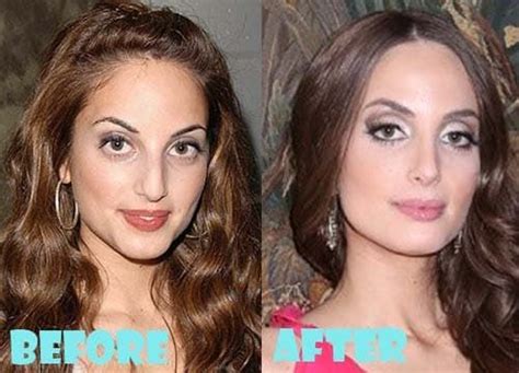 Mila Kunis Before And After Plastic Surgery