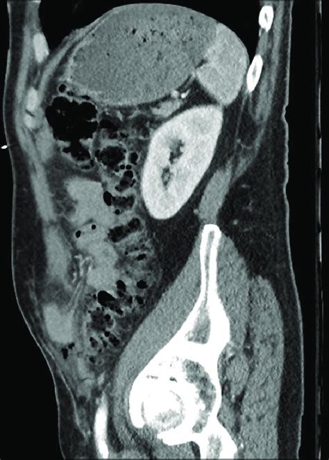 Sagittal Computed Tomography View Of The Spigelian Hernia The Defect