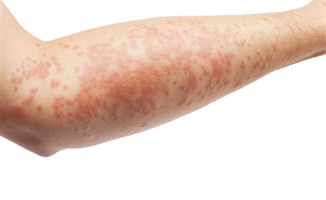 Common Skin Rashes Pictures Causes And Treatments United States