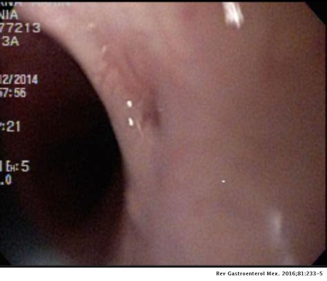 Endoscopic Treatment Of Recurrent Tracheoesophageal Fistula With A